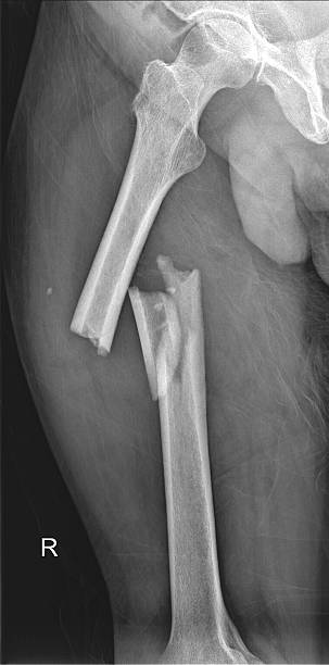 Open fracture symposium.